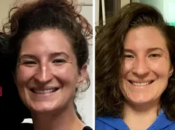 Foto Sebelum dan Sesudah Operasi Plastik Bikin Tercengang