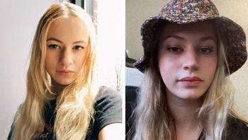 Sebelum dan sesudah operasi hidung. Foto: Brightside