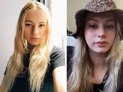 Foto Sebelum dan Sesudah Operasi Plastik Bikin Tercengang