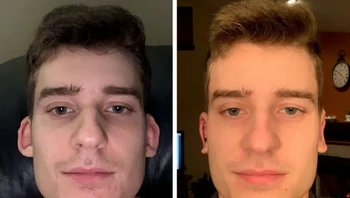 Sebelum dan sehari setelah operasi Otoplasti Foto: Brightside