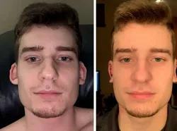 Foto Sebelum dan Sesudah Operasi Plastik Bikin Tercengang