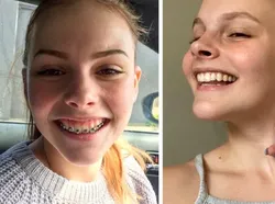 Foto Sebelum dan Sesudah Operasi Plastik Bikin Tercengang