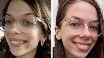 Perempuan ini melakukan operasi rekonstruksi daun telinga saya Foto: Brightside