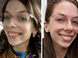 Foto Sebelum dan Sesudah Operasi Plastik Bikin Tercengang