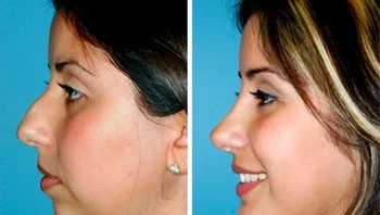 Wanita ini melakukan implan dagu dan operasi hidung Foto: Brightside