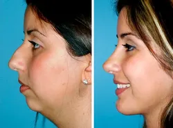 Foto Sebelum dan Sesudah Operasi Plastik Bikin Tercengang