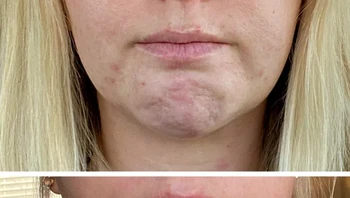 Perempuan ini menggunakna Botox untuk memperbaiki dagunya. Foto: Brightside