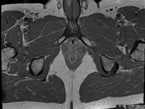 Begini Penampakan Alat Kelamin Pria yang Patah gegara Bercinta