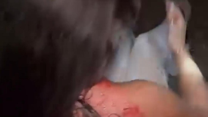 Kepala turis asing perempuan berdarah karena diduga diserang orang dari belakang di kawasan Berawa, Desa Tibubeneng, Kecamatan Kuta Utara, Badung, Bali. (Tangkapan layar story Instagram @saga)