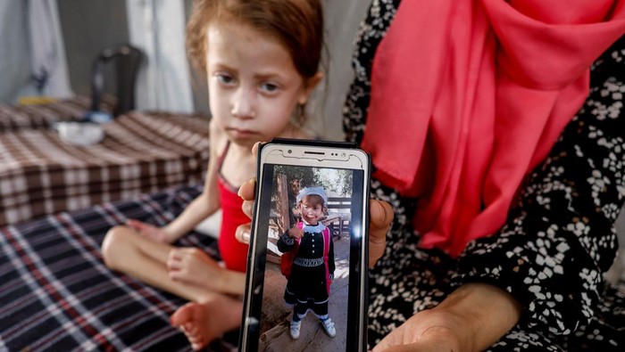 A doctor checks Jana Ayad, a malnourished Palestinian girl, as she receives treatment at the International Medical Corps field hospital, amid the Israel-Hamas conflict, in Deir Al-Balah in the southern Gaza Strip, June 22, 2024. REUTERS/Mohammed Salem TPX IMAGES OF THE DAY