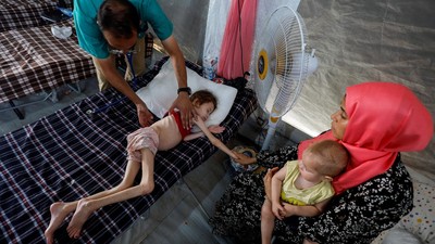 Potret Pilu Anak-anak di Gaza Menderita Malnutrisi