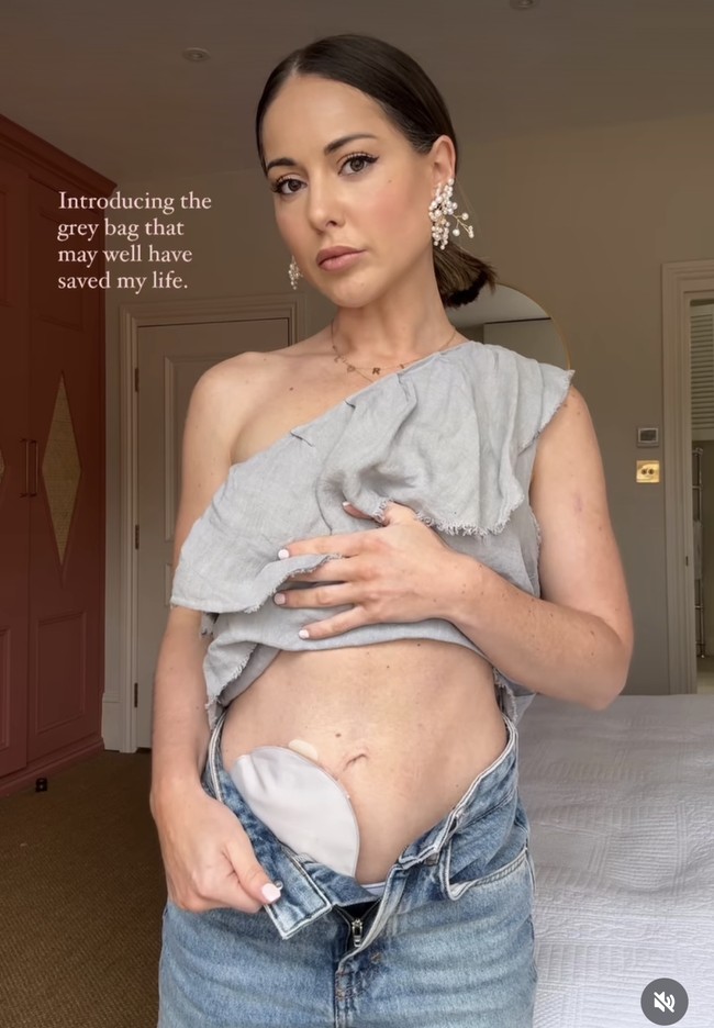 Perjuangannya melawan berbagai penyakit ini telah membuatnya harus menggunakan kantung stoma untuk menampung kotoran, sebuah kondisi yang sering kali dipandang dengan stigma negatif oleh masyarakat. Foto: Dok. Instagram