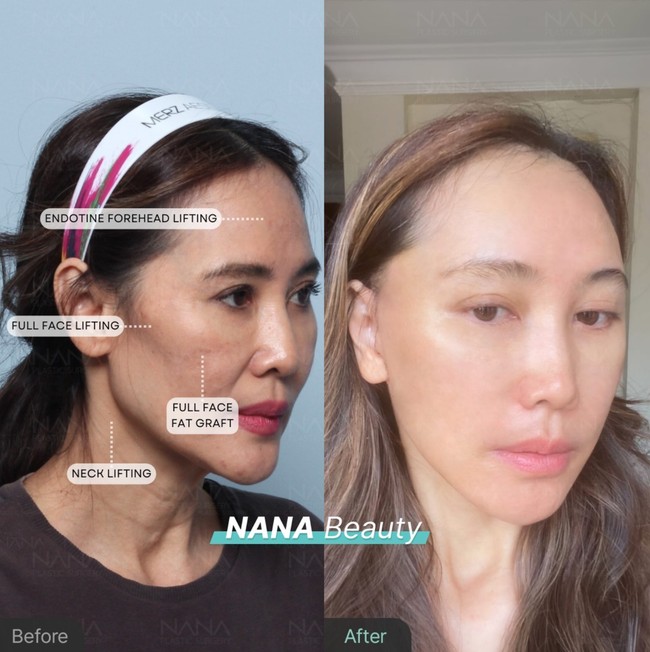 Klinik kecantikan tersebut juga merilis perbandingan foto Ina sebelum dan setelah menjalani operasi anti aging tersebut. Setelah 21 hari terlihat wajah Ina menjadi lebih kencang dan glowing. Foto: Instagram/@nanahospital.id