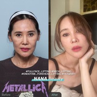 Potret perbandingan wajah Ina Thomas 30 hari setelah operasi anti aging. Penampilan wanita 49 tahun itu pun jadi terlihat semakin fresh dan awet muda. Foto: Instagram/@nanahospital.id