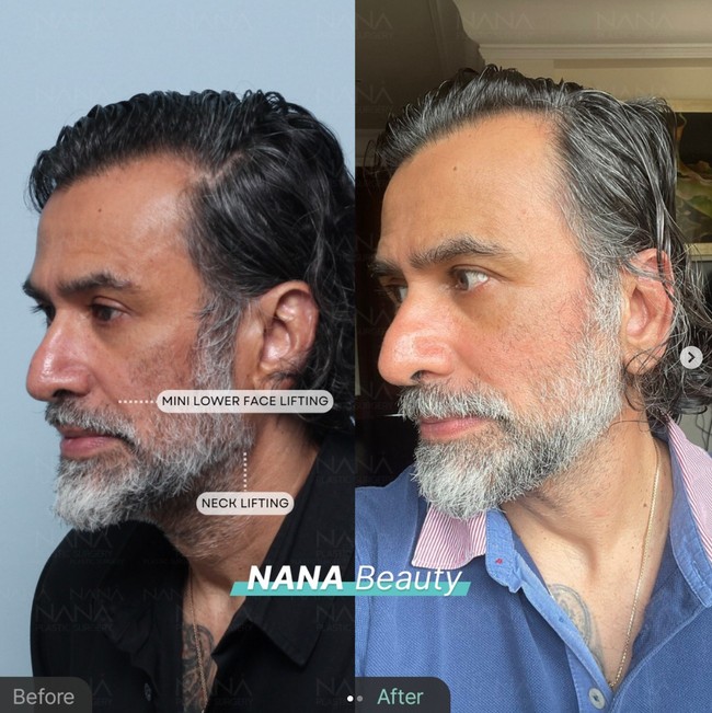 Hampir sama seperti Ina, wajah sang suami, Jeremy Thomas, juga jadi terlihat lebih kencang usai menjalani treatment tersebut. Disebutkan bahwa Jeremy menjalani tindakan mini lower face lifting dan neck lifting. Berbeda dengan sang istri yang menjalani endotine forehead lifting, full face lifting, neck lifting, dan full face fat graft. Foto: Instagram/@nanahospital.id