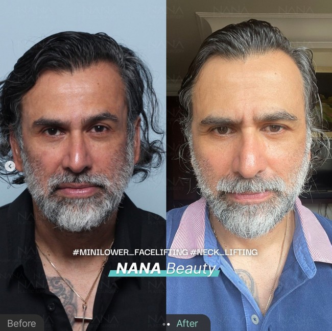 Kini wajah Jeremy terlihat lebih cerah, kerutan dan flek pun tersamarkan. Pria 52 tahun itu pun jadi semakin terlihat awet muda. Foto: Instagram/@nanahospital.id