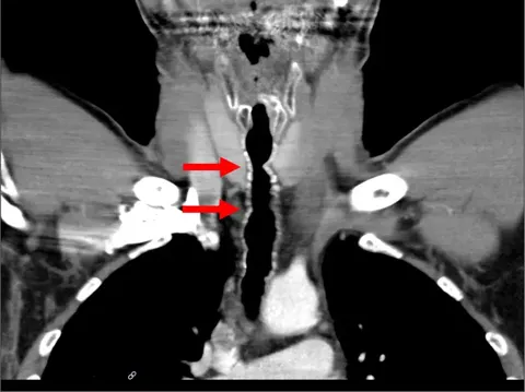 Efek samping merokok yang aneh terjadi di tubuh seorang pria asal Austria. Rambut tumbuh di tenggorokannya. Ini hasil scan yang menunjukkan lokasi pertumbuhan rambut tersebut.