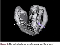 Awal Mula Temuan Janin Berukuran 18 Cm di Kepala Anak Berusia 1 Tahun