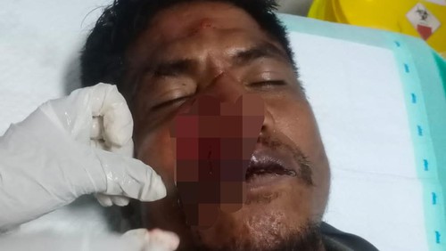 Aloysius Marabijala babak belur dianiaya kades di Kampung Kabara Kowe, Desa Manola, Kecamatan Loli, Sumba Barat, NTT, Kamis (18/7/2024). (Dok. Polres Sumba Barat)