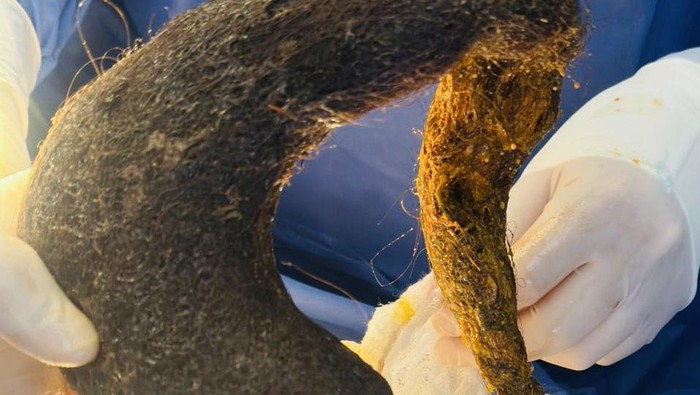 Dokter Temukan Nyaris 1 Kg Bola Rambut di Perut Wanita, Ini Awal Mulanya