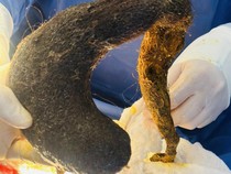 Dokter Temukan Nyaris 1 Kg Bola Rambut di Perut Wanita, Ini Awal Mulanya