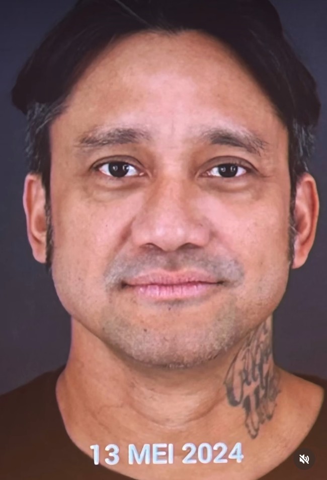 Inilah wajah sebelum perawatan tersebut. Area mata Tora mengalami penurunan, dengan kantung mata atau eyebag yang mencolok. Kulit di area tersebut kehilangan dukungan, sehingga membuat wajah tampak lebih tua. Selain itu, ada penurunan pada pipi kanan yang lebih menonjol dibandingkan pipi kiri, serta sudut bibir kanan yang lebih turun, jelas Dr. Jill Silfanus dari Miracle Clinic. Foto: dok. Instagram