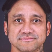 Inilah wajah sebelum perawatan tersebut. Area mata Tora mengalami penurunan, dengan kantung mata atau eyebag yang mencolok. Kulit di area tersebut kehilangan dukungan, sehingga membuat wajah tampak lebih tua. Selain itu, ada penurunan pada pipi kanan yang lebih menonjol dibandingkan pipi kiri, serta sudut bibir kanan yang lebih turun, jelas Dr. Jill Silfanus dari Miracle Clinic. Foto: dok. Instagram