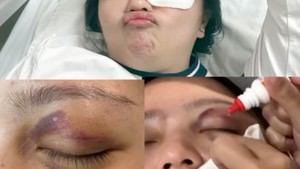 Salah satu sahabat Gritte Agatha terkena bola di bagian mata hingga harus dilarikan ke rumah sakit. Foto: Instagram/@gritteagathaa