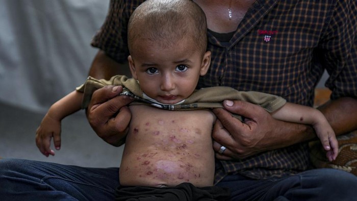 Nasib Anak-anak di Gaza Kini Dihantui Penyakit Kulit Menular