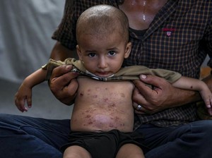 Nasib Anak-anak di Gaza Kini Dihantui Penyakit Kulit Menular