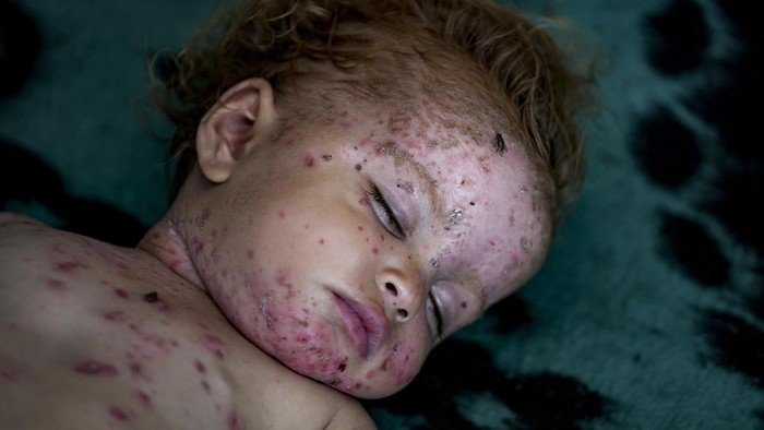 Displaced child Sham al-Hessi, center, who suffers from skin disease, is covered with skin cream as she poses for a picture, at a makeshift tent camp in Deir al-Balah, central Gaza Strip, Monday, July 29, 2024. Skin diseases are running rampant in Gaza, health officials say, from appalling conditions in overcrowded tent camps housing hundreds of thousands of Palestinians driven from their homes. (AP Photo/Abdel Kareem Hana )