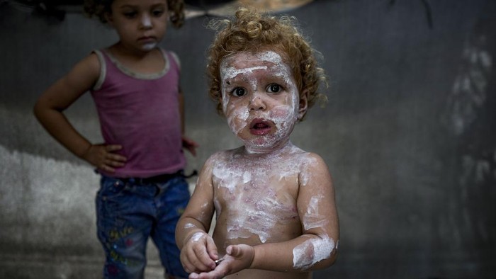 Displaced child Sham al-Hessi, center, who suffers from skin disease, is covered with skin cream as she poses for a picture, at a makeshift tent camp in Deir al-Balah, central Gaza Strip, Monday, July 29, 2024. Skin diseases are running rampant in Gaza, health officials say, from appalling conditions in overcrowded tent camps housing hundreds of thousands of Palestinians driven from their homes. (AP Photo/Abdel Kareem Hana )