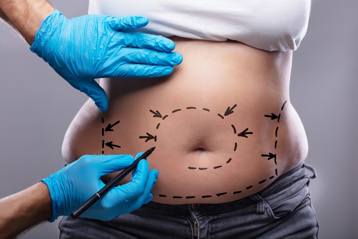 Close-up Of Plastic Surgeon In Blue Gloves Drawing On Womans Stomach With Pen For Surgery