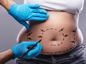 Sedot Lemak Berujung Petaka, IDI Angkat Bicara soal Dokter-Klinik Berkualitas