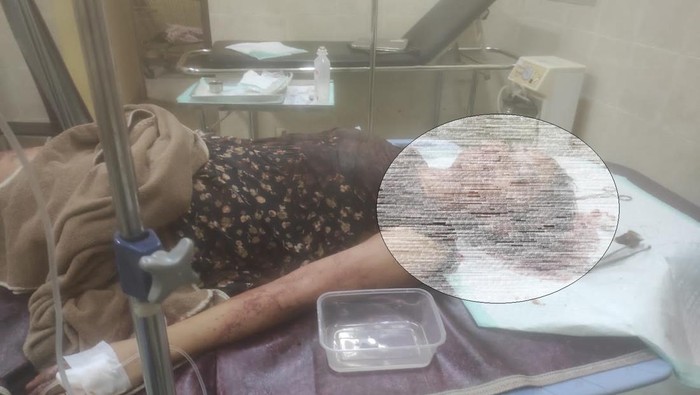 Meliani menjalani perawatan di rumah sakit akibat dibacok pacarnya di kosan.