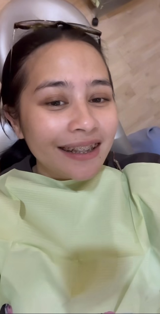 Begini penampilan Prilly usai memasang behel permanen untuk giginya di dokter. Dengan behel tersebut penampilan Prilly pun jadi terlihat sedikit berubah. Foto: Instagram/@prillylatuconsina96