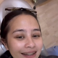 Begini penampilan Prilly usai memasang behel permanen untuk giginya di dokter. Dengan behel tersebut penampilan Prilly pun jadi terlihat sedikit berubah. Foto: Instagram/@prillylatuconsina96