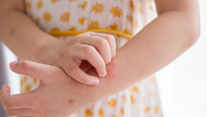 Little girl has skin rash allergy itching and scratching on her arm