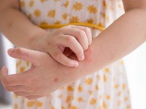 Mengenal Sindrom Steven Johnson yang Dikaitkan dengan Kondisi Jokowi