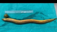 Selain benda, ada juga kasus temuan belut hidup bersarang di usus pasien. Pasien mengatakan kepada staf rumah sakit, ia telah memasukkan belut hidup yang panjangnya kira-kira 65 cm melalui anus demi kepuasan seks, sesaat sebelum mulai mengalami nyeri perut yang luar biasa. (Foto: Rumah Sakit Universitas Viet Duc).