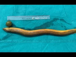 Merinding! Dokter Keluarkan Belut Besar dari Usus Manusia