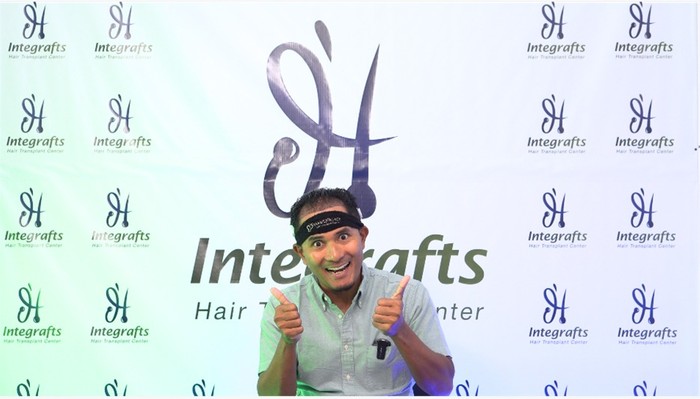 Ikuti Jejak Mathias Muchus-Tanta Ginting Transplantasi Rambut di Indonesia