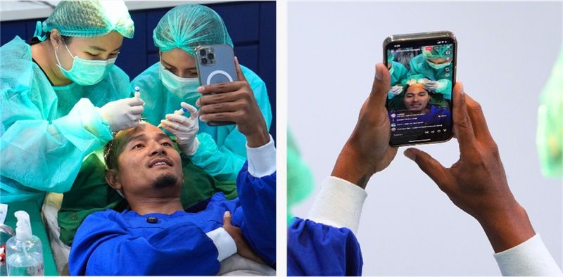 Ikuti Jejak Mathias Muchus-Tanta Ginting Transplantasi Rambut di Indonesia