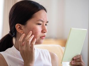 5 Penyebab Jerawat yang Sering Terjadi, Hati-hati Cuaca Panas!