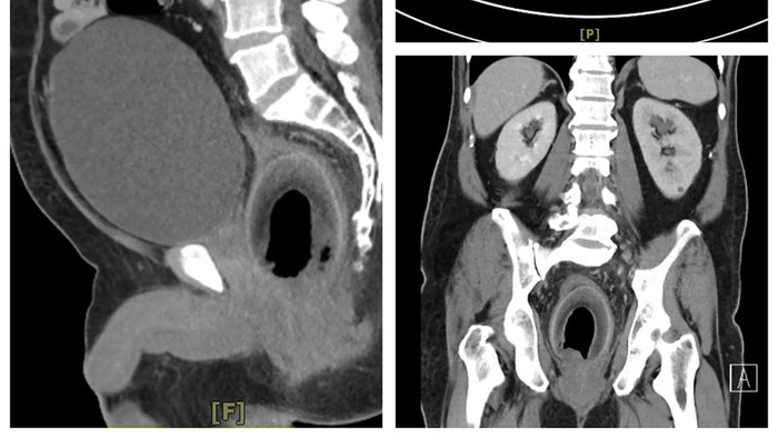 Ngilu! Dokter Keluarkan Kelapa yang Nyangkut di Dubur Pria Taiwan