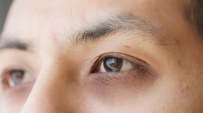 6 Gejala Penyakit Liver yang Bisa Muncul di Mata-Leher