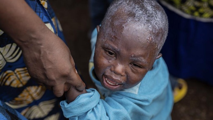 A health worker attends to a girl suffering from mpox, at a treatment centre in Munigi, eastern Congo, Friday, Aug. 16, 2024. (AP Photo/Moses Sawasawa)