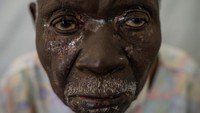 Christophe Chavilinga, 90, yang menderita mpox, menunggu perawatan di sebuah klinik di Munigi, Kongo timur, Jumat, 16 Agustus 2024.  