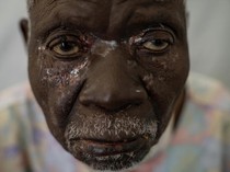 Kongo Darurat Cacar Monyet, Tewaskan 548 Orang