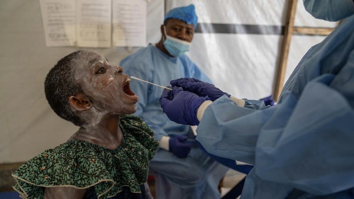 A health worker attends to a girl suffering from mpox, at a treatment centre in Munigi, eastern Congo, Friday, Aug. 16, 2024. (AP Photo/Moses Sawasawa)
